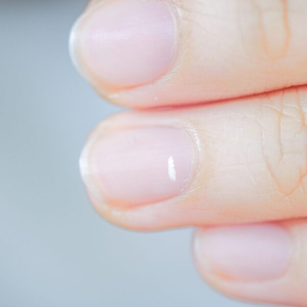 Weiße Flecken auf den Nägeln